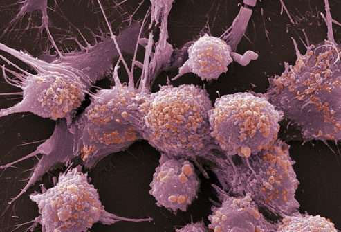 تجويع الخلايا السرطانية افضل الوسائل والمعالجات للقضاء عليها